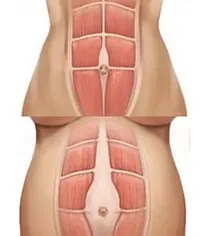 Anatomia della diastasi addominale