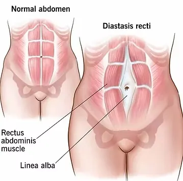 Schema della diastasi dei muscoli retti